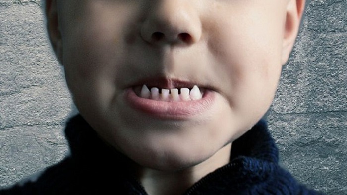 extraen_mas_de_500_dientes_a_nino_en_india.jpg_219914347